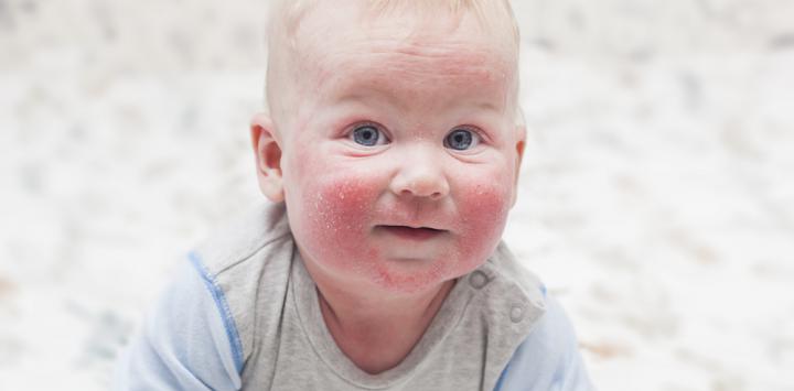Ciertos niveles de nicotina mina en la dieta de la madre permiten una respuesta inmune ante los eczemas.